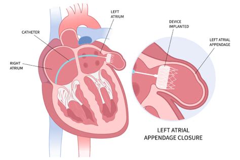 Left Atrial Appendage Closure (LAAC) - Auburn Cardiology Centre