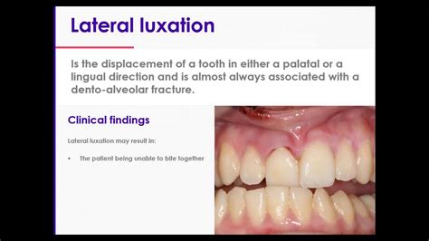 Tooth Luxation