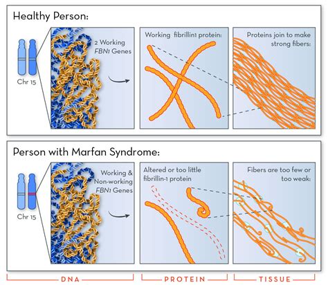 Marfan Syndrome