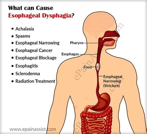 The causes of esophageal dysphagia. Esophageal Spasm, Esophageal Cancer ...