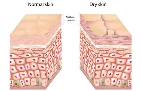 Dry Skin - Causes, Prevention and Treatments What Woman Needs