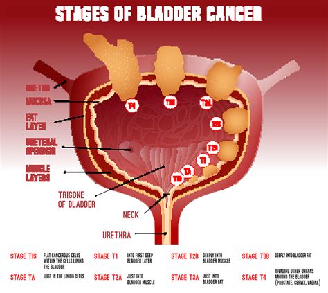 Bladder Cancer - AAUrology