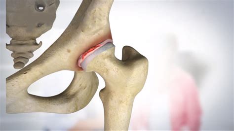 Acetabular Labral Tear (Hip/Groin Pain) - Fortaleza Rehab & Fitness