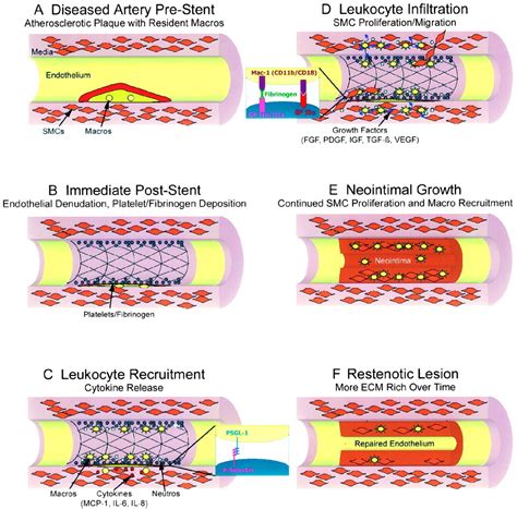 Inflammation and Restenosis in the Stent Era | Arteriosclerosis ...