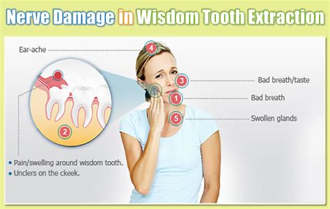 Paresthesias (Nerve damage) after Wisdom tooth extraction