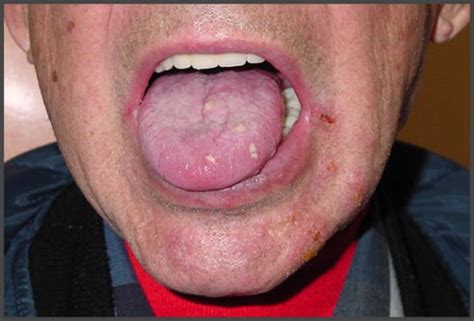 Shingles in mouth pictures | Shingles Expert