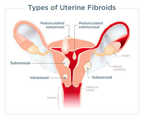 Focused Ultrasound for Uterine Fibroids - Sperling Medical Group