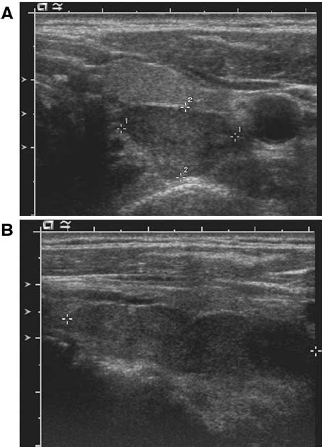 Ultrasound examination of the thyroid gland. Ultrasound of the thyroid ...