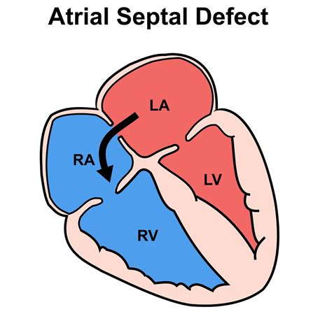 Atrial Septal Defect Causes Symptoms Types Diagnosis Treatment | Images ...