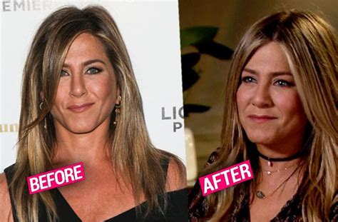 More Plastic Surgery? Jennifer Aniston Gets Fillers For Plumper Cheeks ...