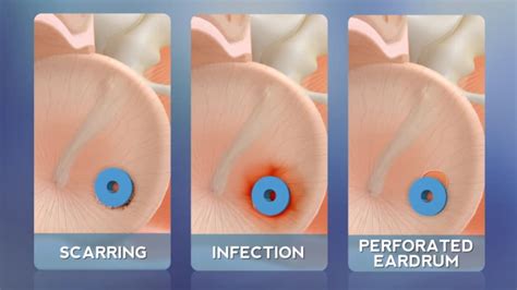 Ear Tubes: Post-Op - ENTJC