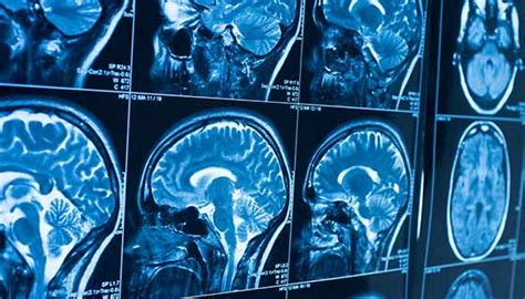 Brain Tumor Types | Johns Hopkins Medicine