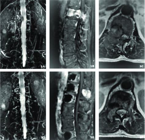 Imaging data for bone metastasis of thyroid cancer treated with PVP and ...