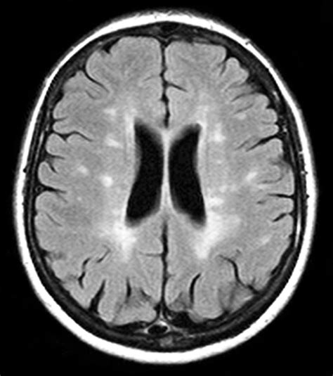 Multiple Sclerosis, Mri Scan Photograph by Du Cane Medical Imaging Ltd