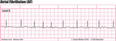 ECG Educator Blog : Atrial Fibrillation (AF)