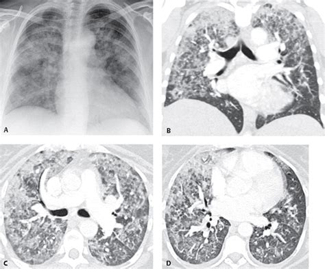 111 Diffuse Alveolar Hemorrhage | Radiology Key