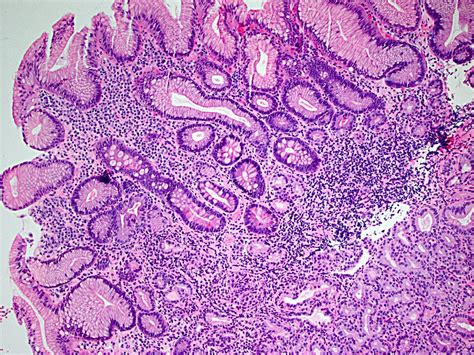 Gastric neuroendocrine tumors, pathology - Carcinoid Cancer Foundation