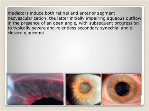 Neovascular glaucoma