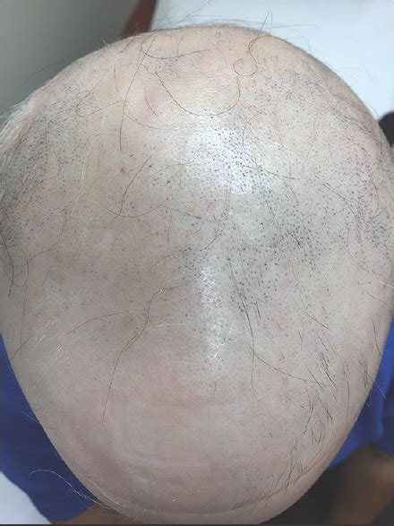 Alopecia Totalis: Causes. Symptoms, & Treatment - Wimpole Clinic