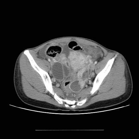 Bilateral tubo-ovarian abscess | Radiology Case | Radiopaedia.org