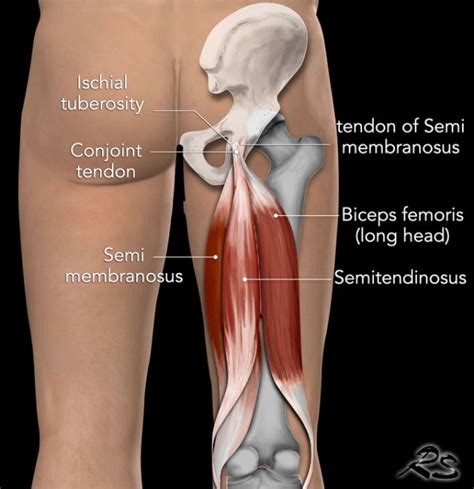 The Radiology Assistant : Hamstring injury