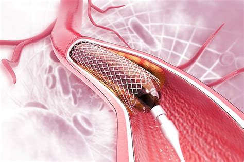 Coronary Artery Stent Placement