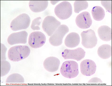 Plasmodium Falciparum Under Microscope