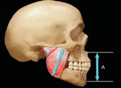 Changing Vertical Dimension: When is it safe? - The Dawson Academy