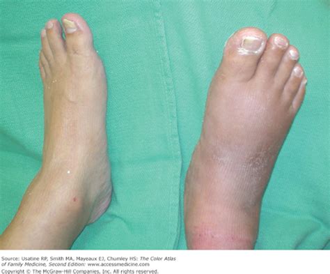 Charcot Arthropathy | Basicmedical Key