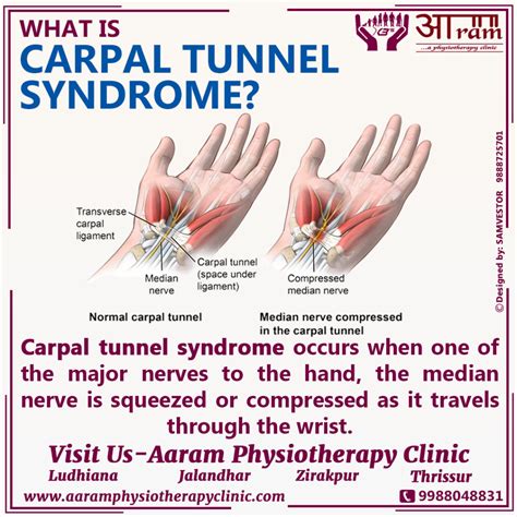 Carpal Tunnel Syndrome (CTS) Definition, Symptoms, Causes & Exercises