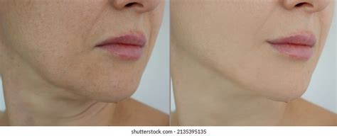 Woman Double Chin Before After Treatment Stock Photo (Edit Now) 1943967145