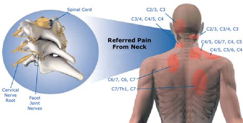 Cervicalgia or Neck Pain: What are the Causes and Treatment Options