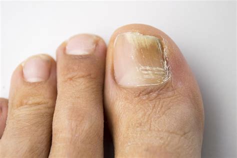 Fungal nail problems - myDr.com.au