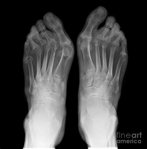 Rheumatoid Arthritis X Ray Foot