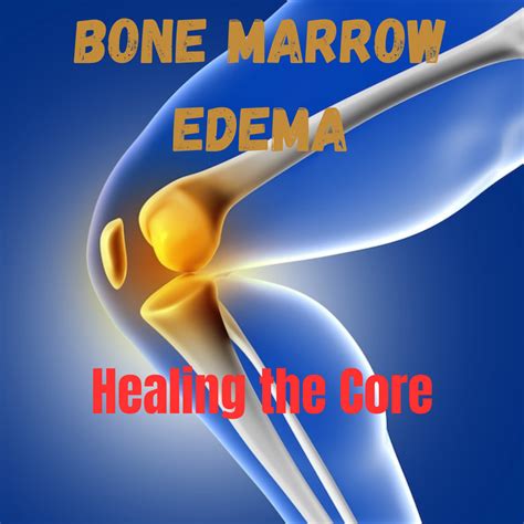 5 Proven Strategies to Overcome Bone Marrow Edema and Reclaim Your ...