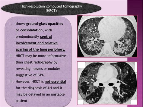 PPT - ALVEOLAR HEMORRHAGE SYNDROMES PowerPoint Presentation, free ...