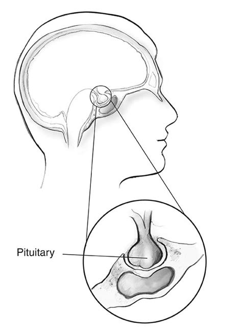 Prolactinoma - NIDDK