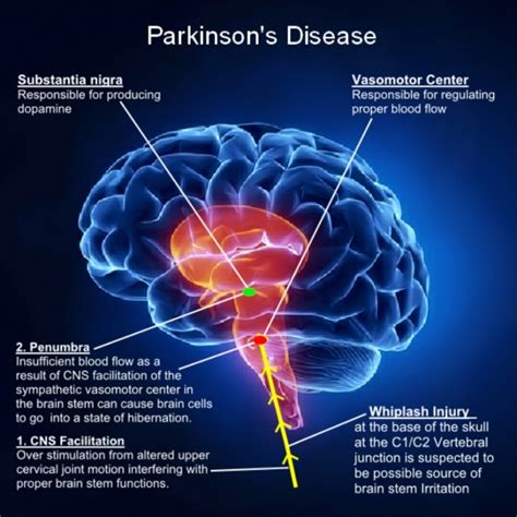 How To Cure And What To Avoid In Parkinson’s Disease?