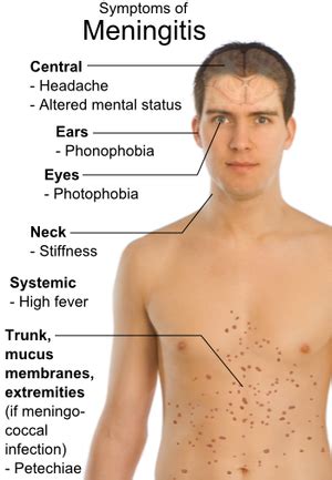 Meningitis - Physiopedia