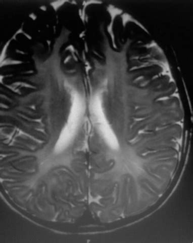 PMD leukodystrophy :MRI - Sumer's Radiology Blog