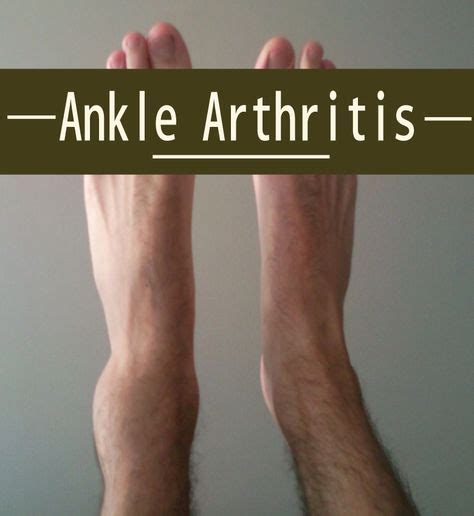 Ankle arthritis