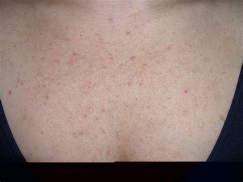 Folliculitis, Pityrosporum (Malassezia Folliculitis) - Dermatology Advisor