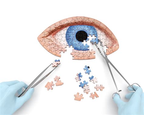 Glaucoma surgery - Ophthalmic Surgeons