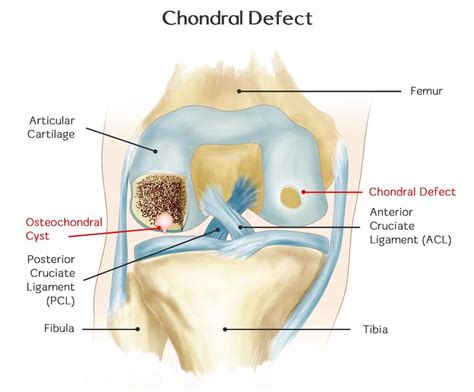 Osteochondral Lesion | Rehab My Patient