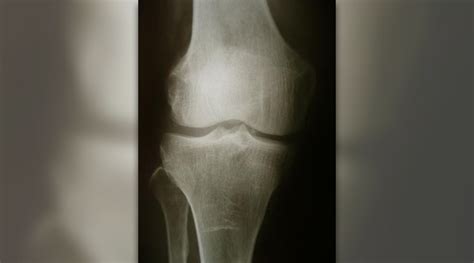 Patellar reflex facts | General center | SteadyHealth.com