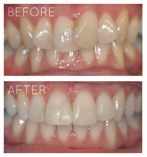 Invisalign Chiswick | Teeth Straightening | Six Month Smiles Wembley