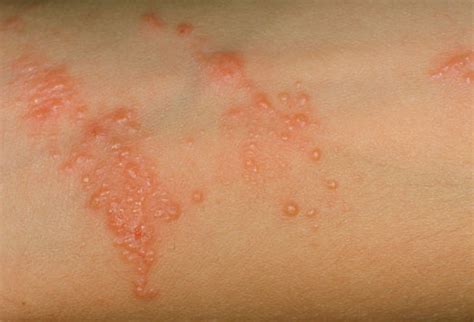 Fungal Rash - Causes, Symptoms, Treatment, Pictures, Infection | Health9