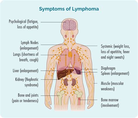 Understanding Burkitt Lymphoma: Causes, Symptoms, and Treatment - Ask ...