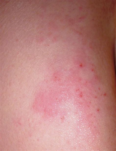 early rash shingles pictures onset | Search Results | Dunia Photo