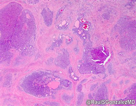 Cholangiocarcinoma Histology